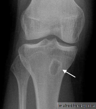 Osteomyelitis