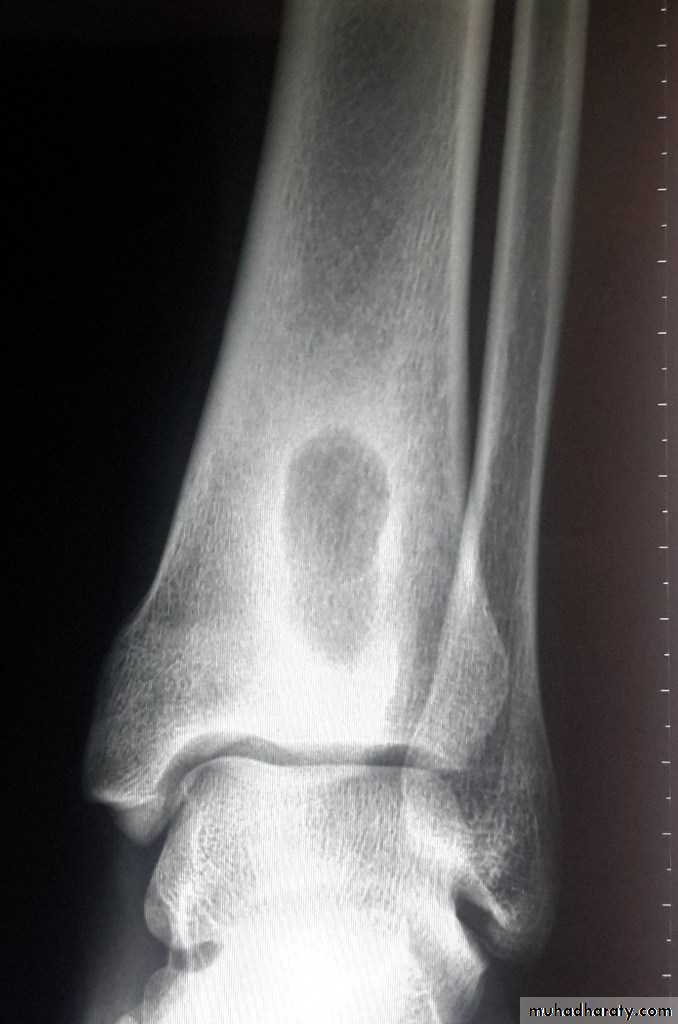 Osteomyelitis
