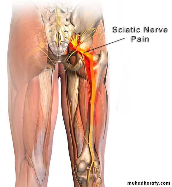 Low Back Pain
