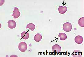 G6PD Deficiency