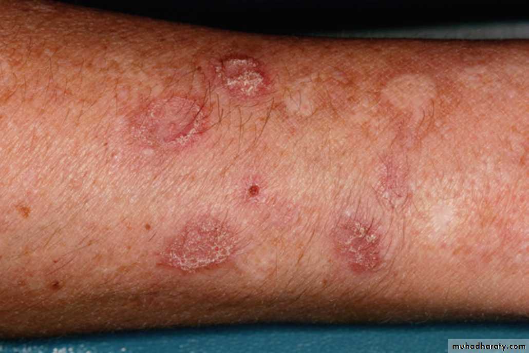Red and white lesions