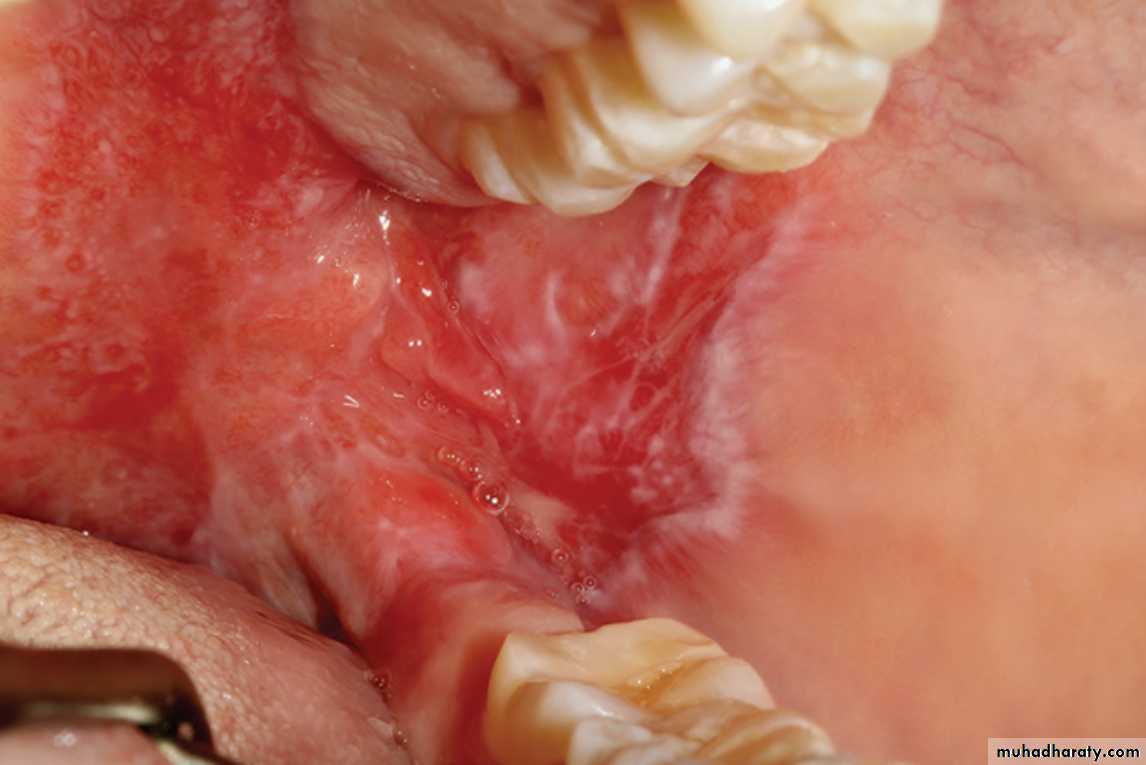 Red and white lesions