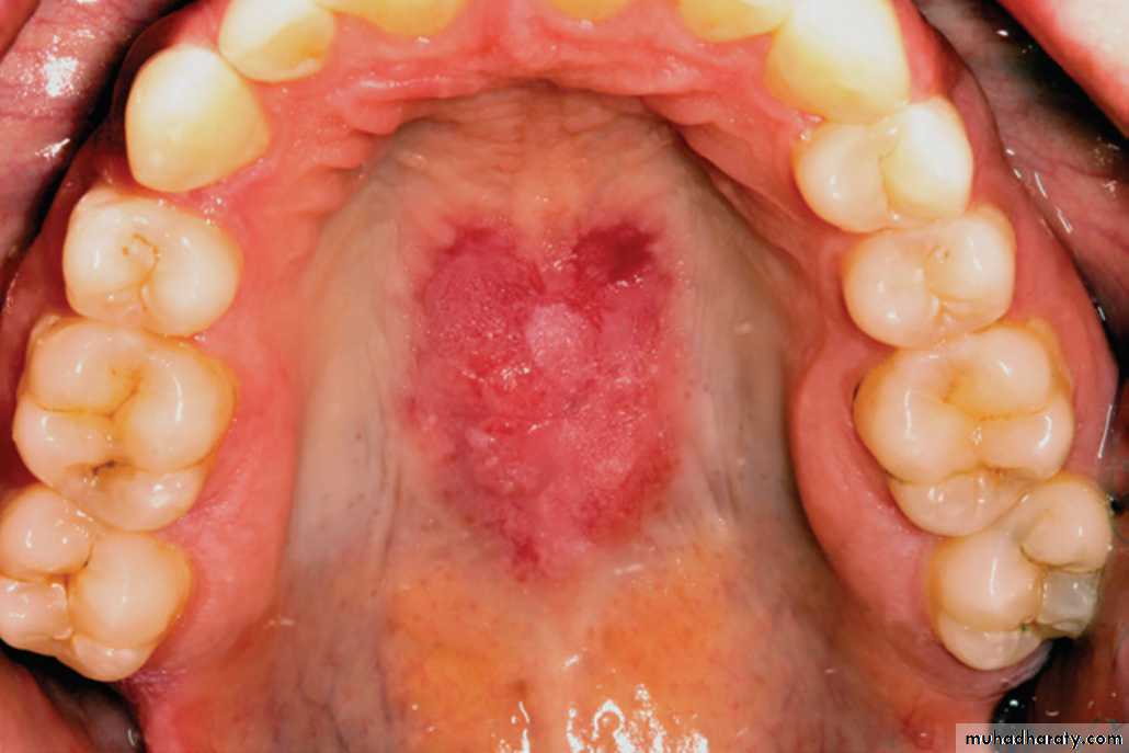 Red and white lesions