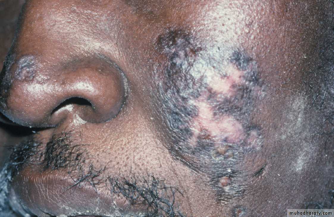 Red and white lesions