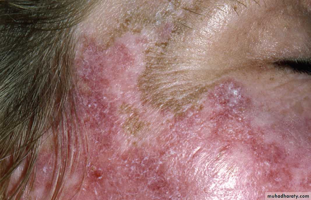 Red and white lesions