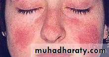 Systemic Lupus Erythematosus