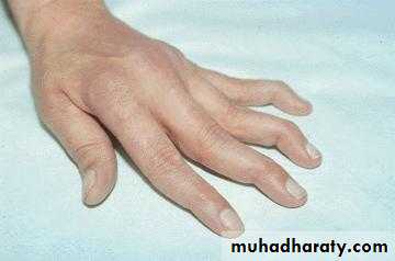 Systemic Lupus Erythematosus