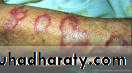 Systemic Lupus Erythematosus