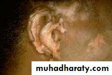 Systemic Lupus Erythematosus