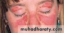 Systemic Lupus Erythematosus
