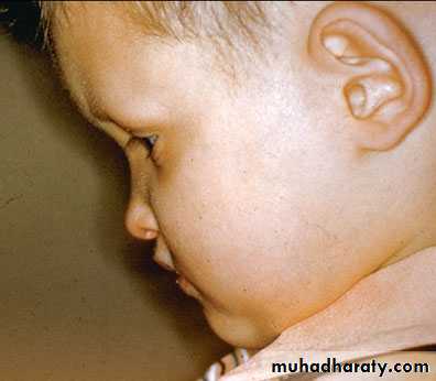 children with special needs