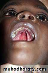 children with special needs