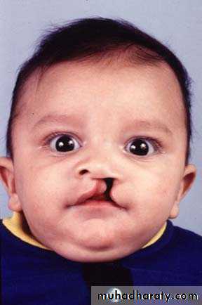children with special needs