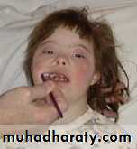 children with special needs