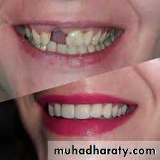 fixed prosthodontics