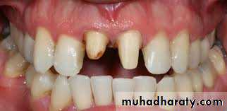 fixed prosthodontics