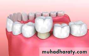 fixed prosthodontics