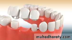 fixed prosthodontics
