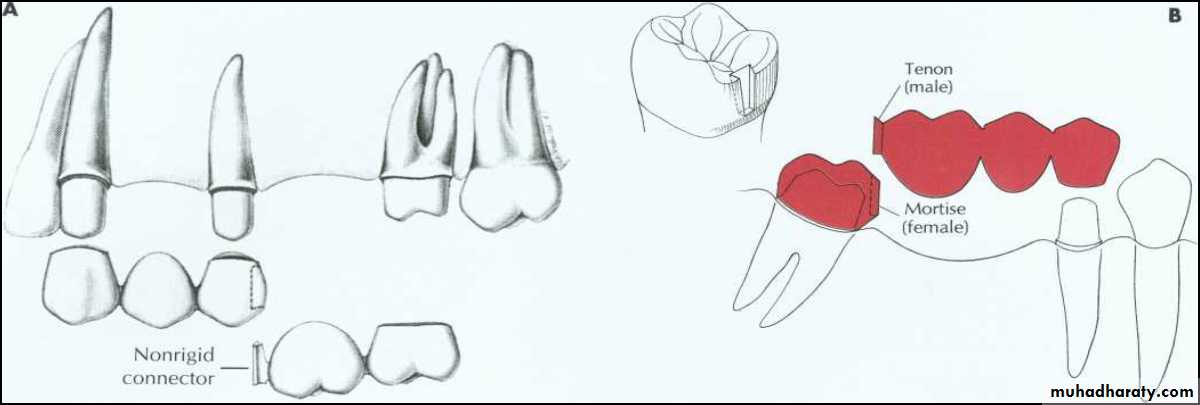 fixed prosthodontics