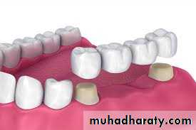 fixed prosthodontics