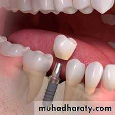 fixed prosthodontics