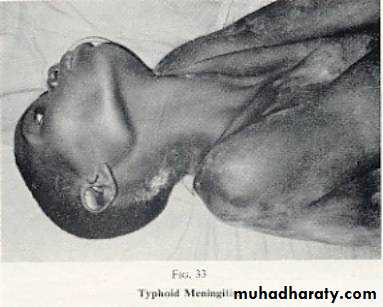 Typhoid Fever