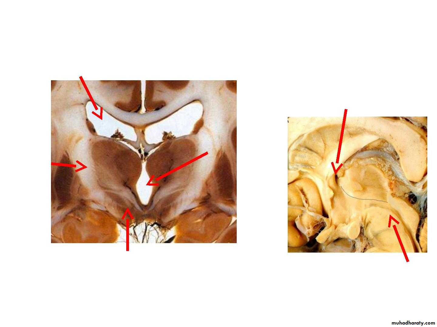 Diencephalon