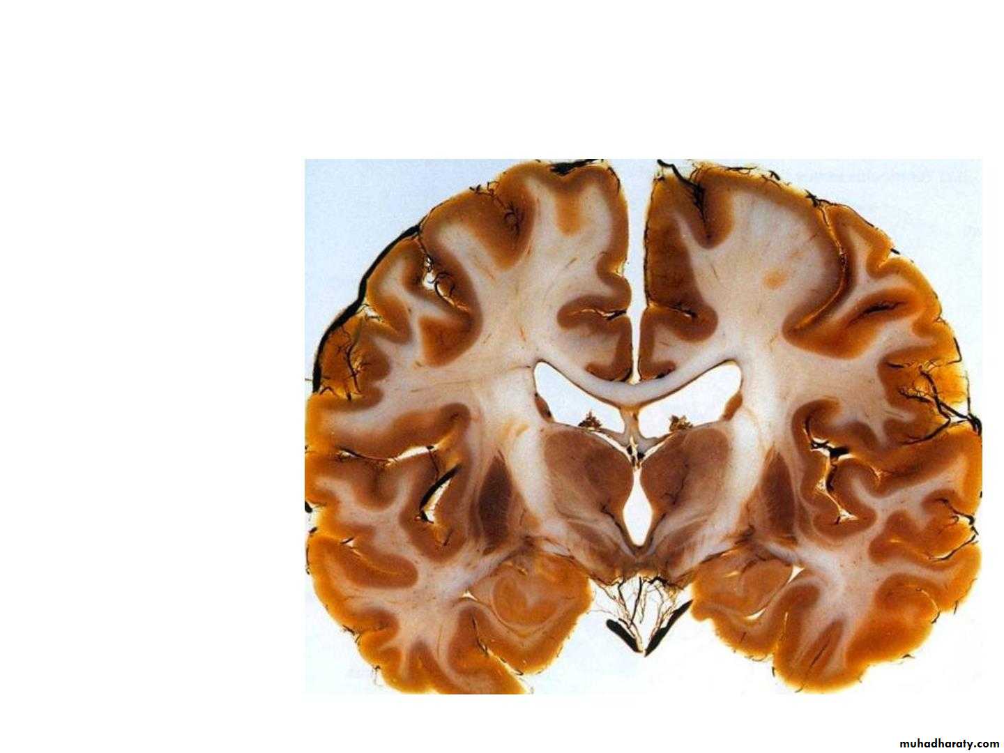Diencephalon