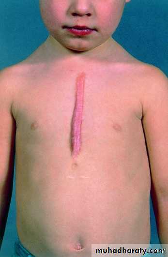 Surgical Incision