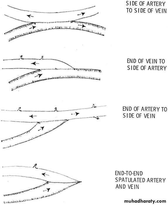 Surgical Incision