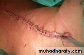 Surgical Incision