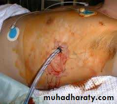 Surgical Incision