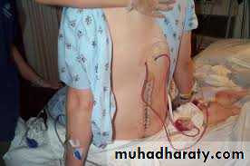 Surgical Incision