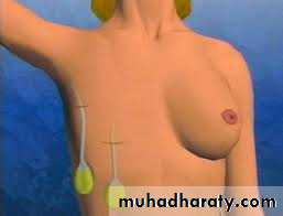 Surgical Incision