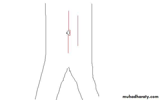 Surgical Incision