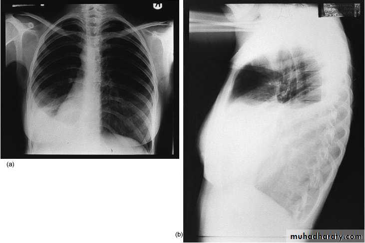 Surgical Incision