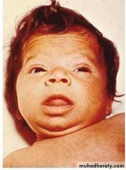 Disorder of Altered Energy Balanced Under-Nutrition Starvation and Famine