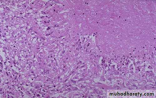 Chronic Inflammation