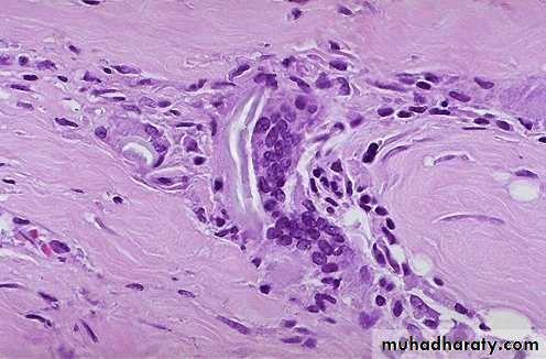 Chronic Inflammation