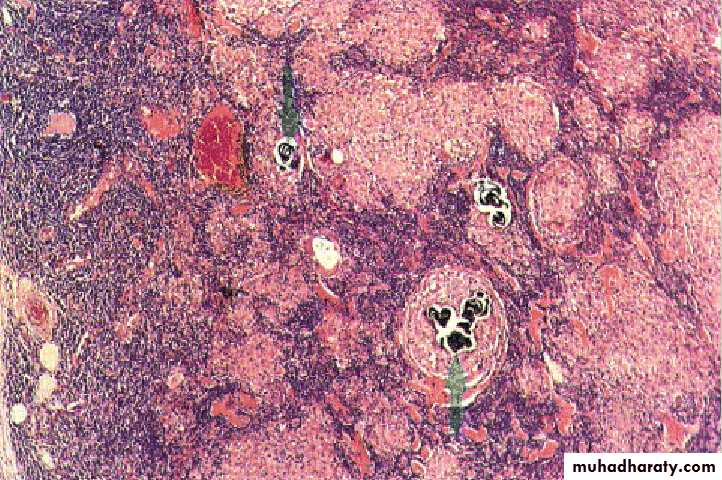 Chronic Inflammation