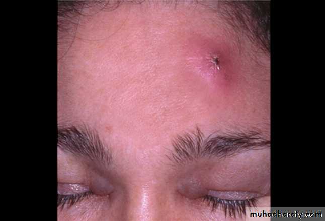 Staphylococci