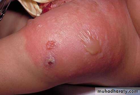 Staphylococci