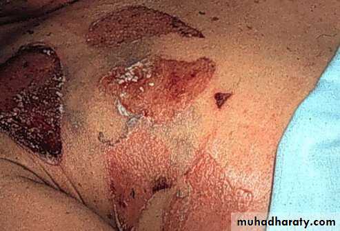 Staphylococci