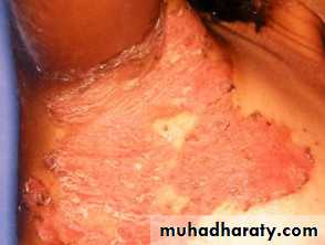 Staphylococci