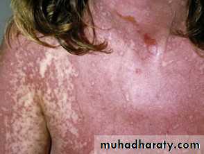 Staphylococci